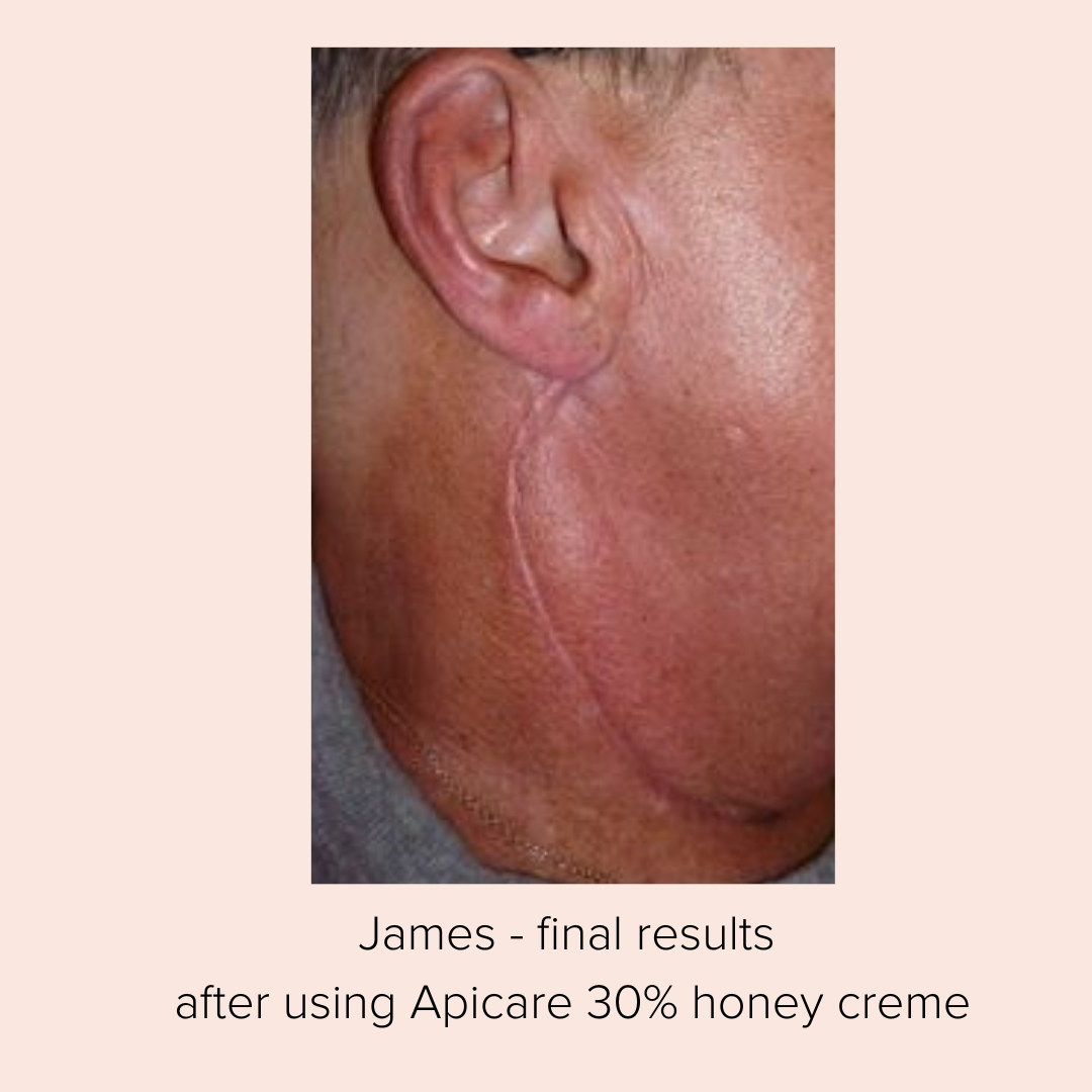 Mānuka Therapy 30% honey creme