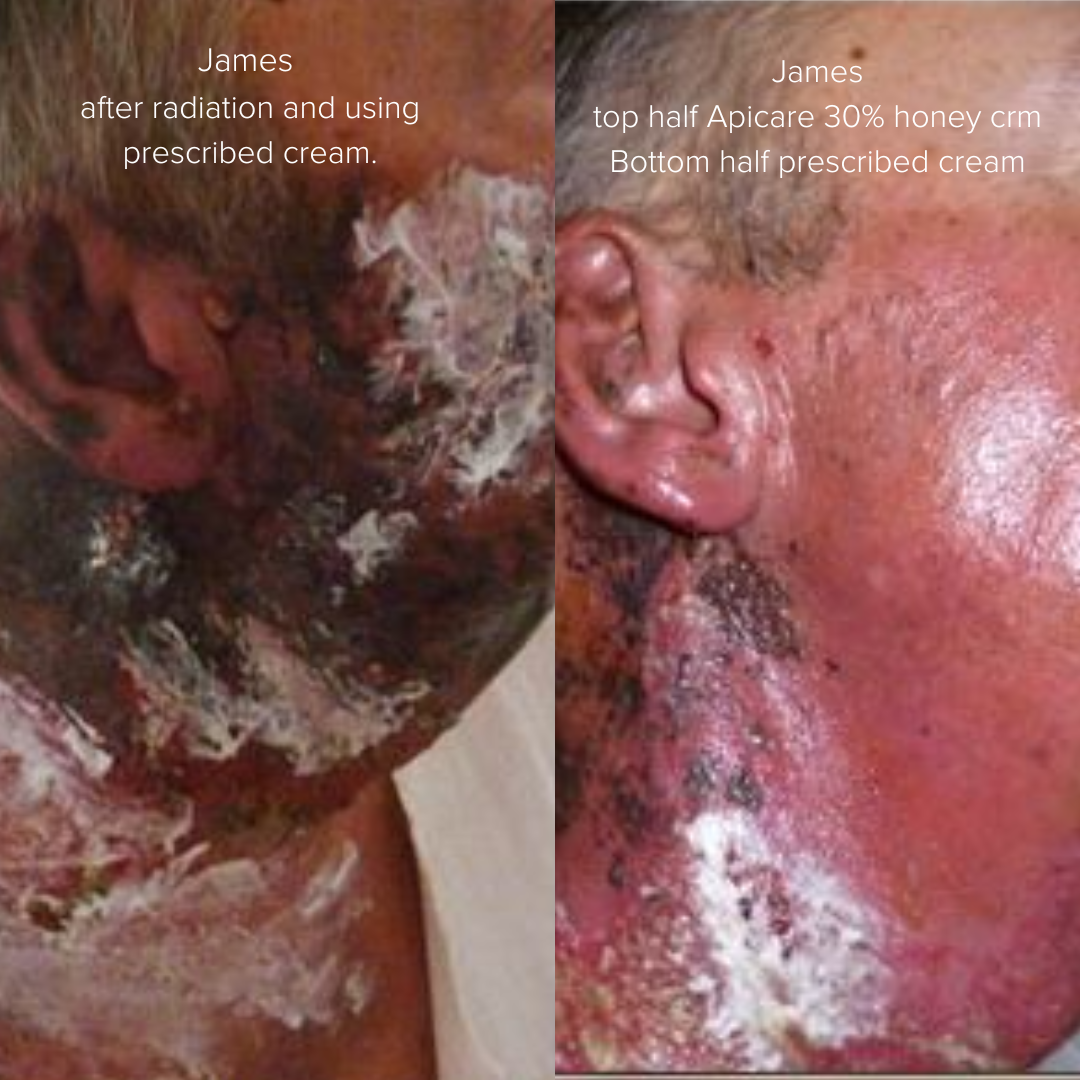 Mānuka Therapy 30% honey creme